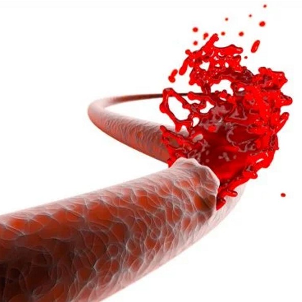 Escala ATRIA para Riesgo de Hemorragia