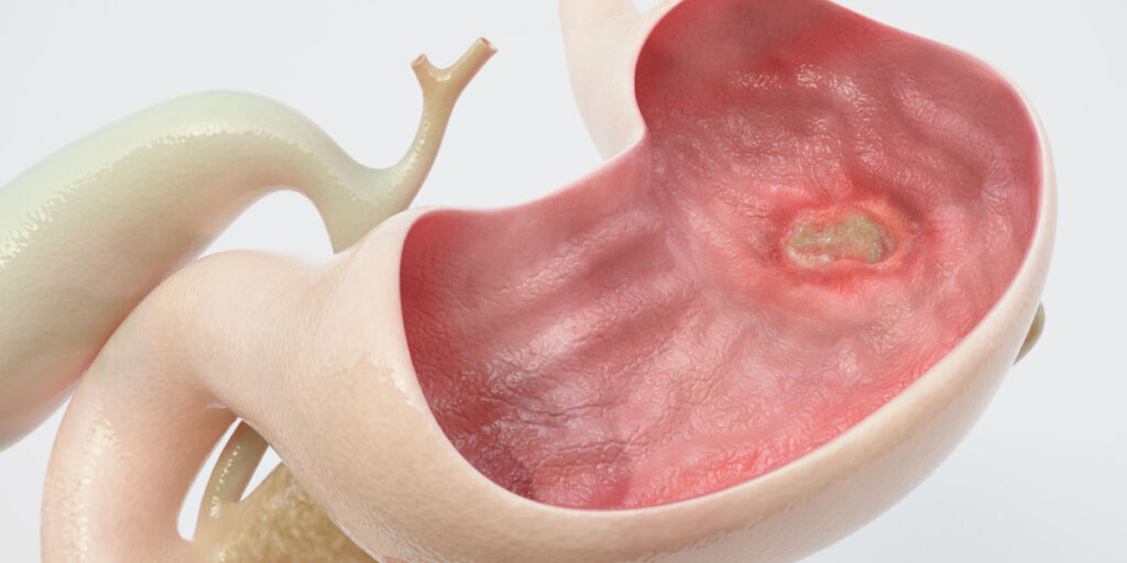 Ulceras gástricas y duodenales causadas por fármacos