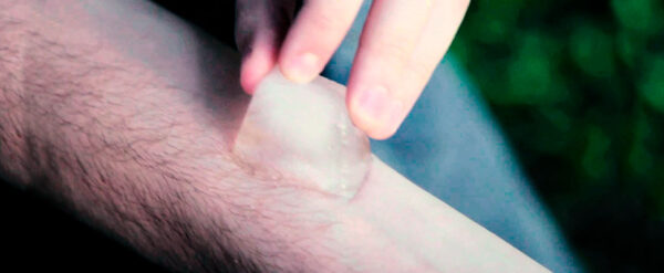 Anestesia por refrigeración