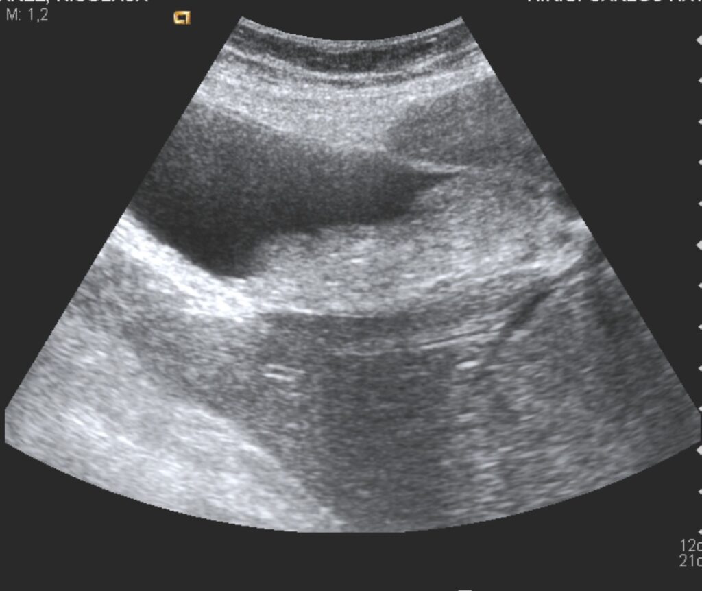 Utilidad de la ecografia en la obstrucción de colédoco distal
