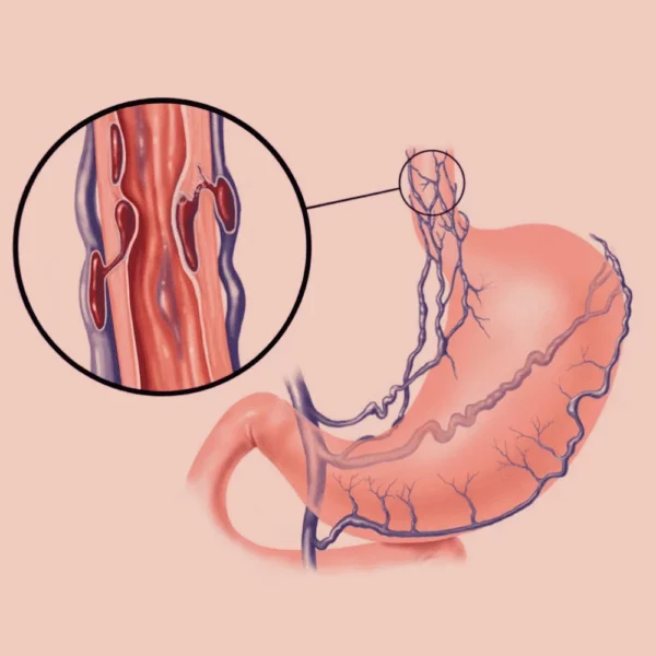 Factores de riesgo de hemorragia por várices esofágicas