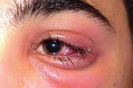 Inflamación idiopática de la órbita