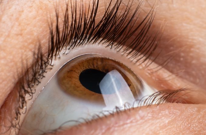 Exposición crónica de la córnea al aire