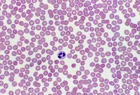 ¿A que trastornos se asocia la leucopenia?