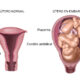 Cambios en el útero durante el embarazo