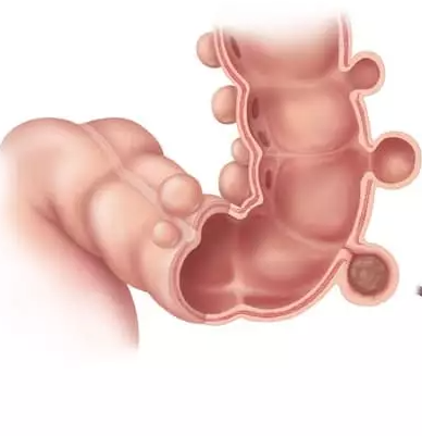 Tratamiento de la diverticulitis no complicada