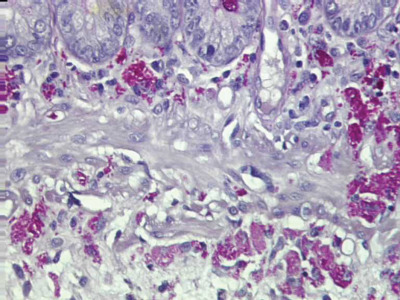 ¿Qué causa la enfermedad de Whipple?