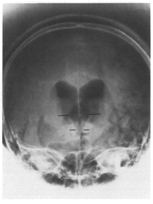 ¿Qué es el síndrome de Nothnagel?