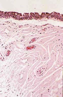 ¿A que se refiere el término amiloidosis?