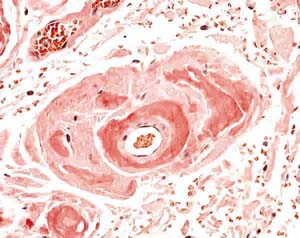 Causa del mal plegamiento de proteínas en la amiloidosis