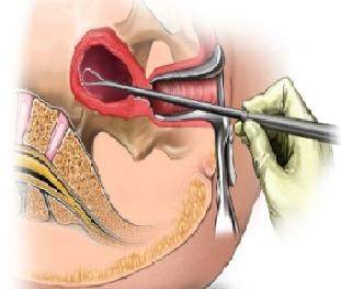 Biopsia de endometrio en sangrados uterinos anormales