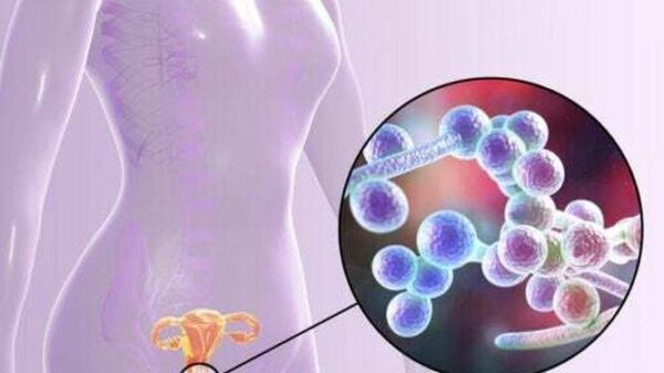 Manifestaciones clínicas de la candidiasis vaginal