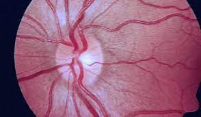 Alteraciones de la papila óptica