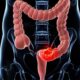 Opciones para detección de cáncer colorrectal