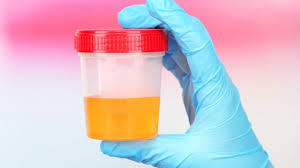 ¿Qué es la orina hipertónica?