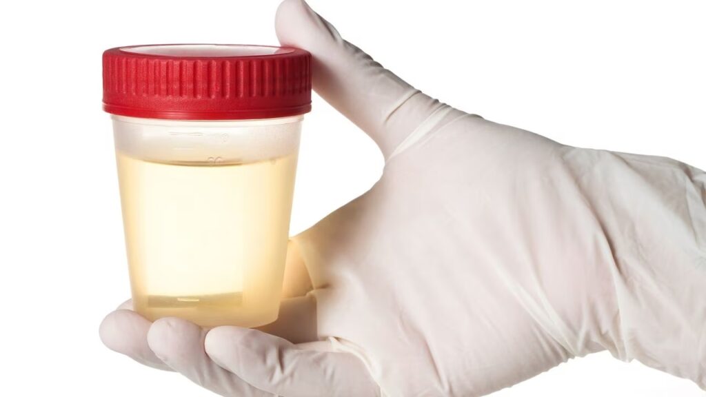 ¿Qué es una orina hipotónica?