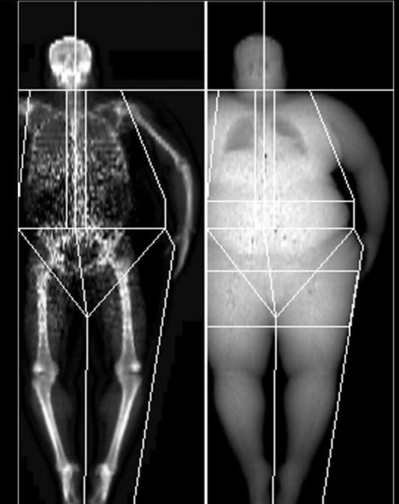 ¿Cuál es el factor predictivo mas preciso de fractura de cadera?