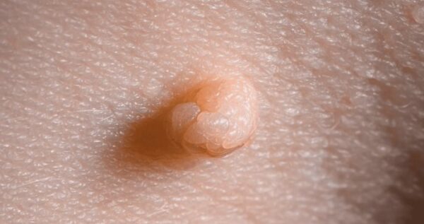 ¿Qué consecuencias tiene la infección por VPH?