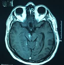 ¿Qué es el síndrome de Weber?