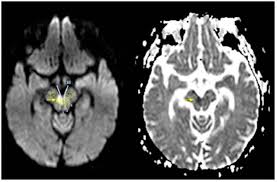¿Qué es el síndrome de Claude?