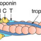 La troponina T (cTnT) y la troponina I cardioespecífica