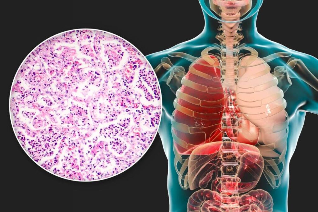 Vacuna antineumocócica polisacárida (PPSV23)