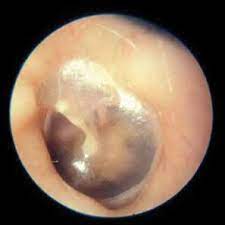 ¿Qué es la otitis media serosa?