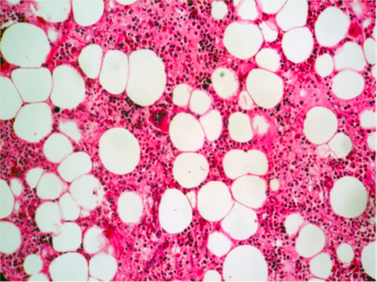 Estados aplásicos de la médula ósea