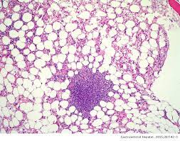 Causas de aplasia de la médula ósea