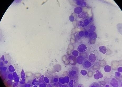 Anemia aplásica inducida por infecciones