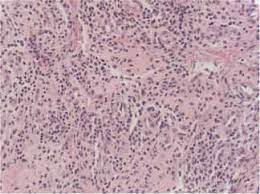 ¿Qué es la Agranulocitosis?