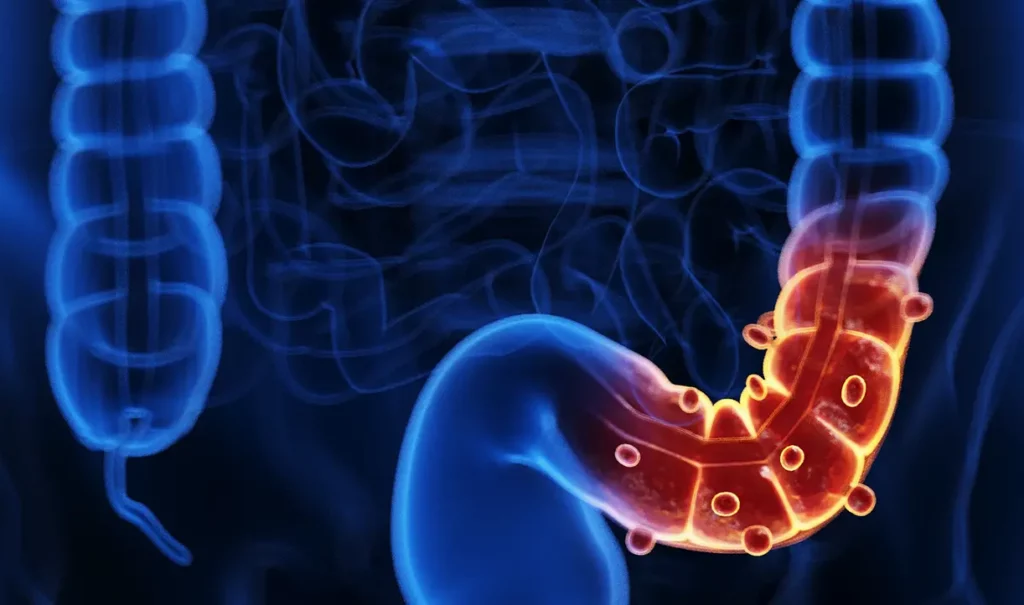 Hemorragia diverticular, alternativas de manejo