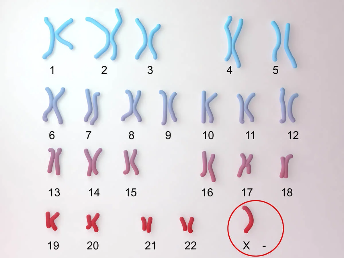 Síndrome de Turner: Alteraciones del cariotipo