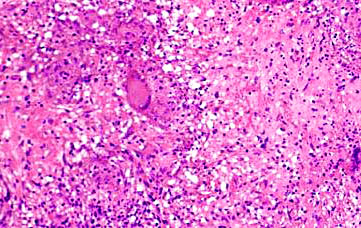 enfermedad de Erdheim-Chester