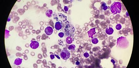 La Enfermedad de Erdheim-Chester (EEC) es una rara forma de histiocitosis