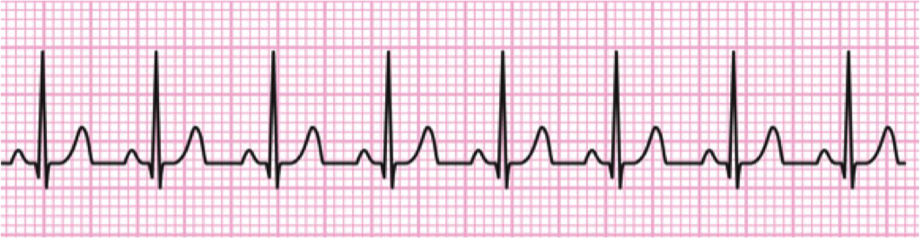 Ritmos sinusales anormales