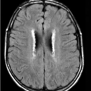 enfermedad de Alexander