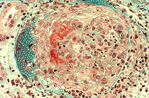poliangitis microscópica