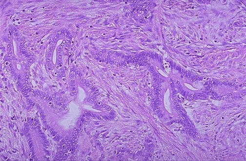 Tipos de neoplasias de intestino grueso