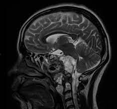 Tumores selares y supraselares