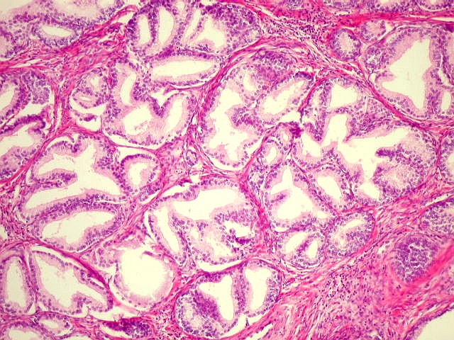 Patología de la hiperplasia benigna de próstata
