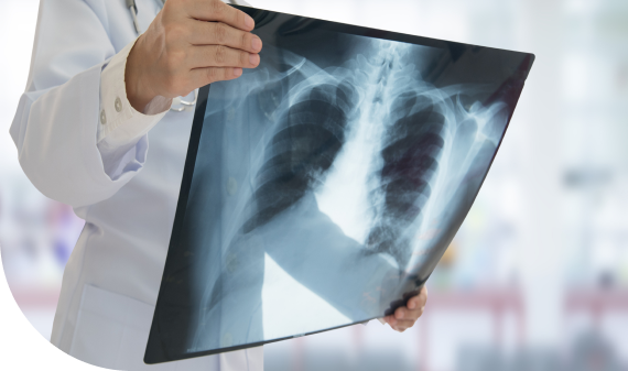 ¿Qué es la Tuberculosis pleural?