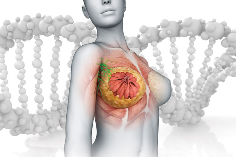 MammaPrint es una herramienta invaluable en la gestión del cáncer de mama