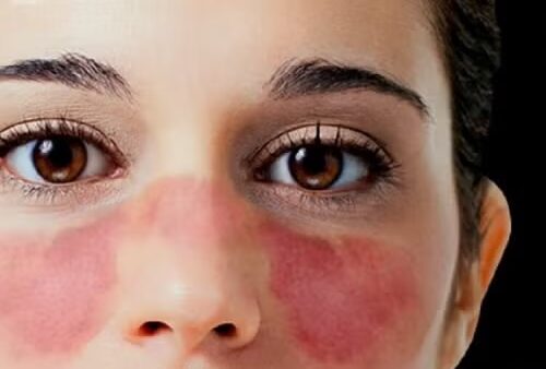 ¿En quienes es mas probable el lupus eritematoso sistémico?