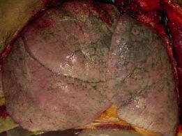 ¿Cuánto pesan los pulmones?