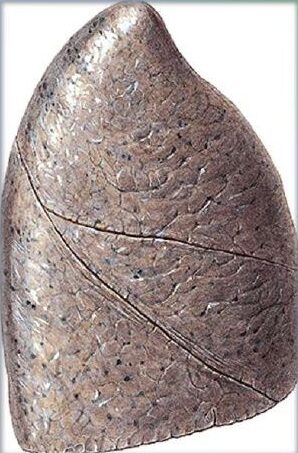 ¿Qué es el vértice pulmonar?