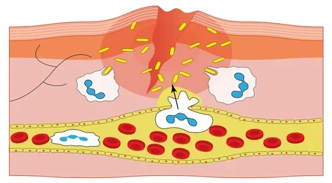 ¿Qué causa una respuesta inflamatoria sistémica?