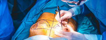 La cirugía de mama aumenta la secreción de prolactina