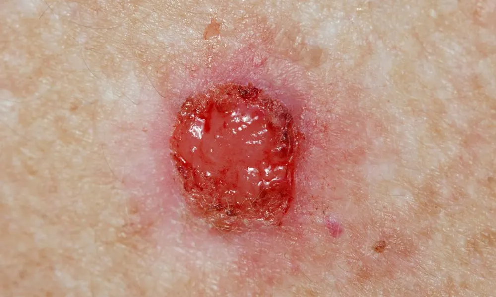 ¿Cuál es el cáncer cutáneo más frecuente?