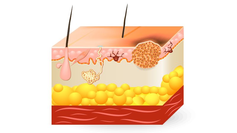 ¿Cómo se clasifica los carcinomas de células basales?